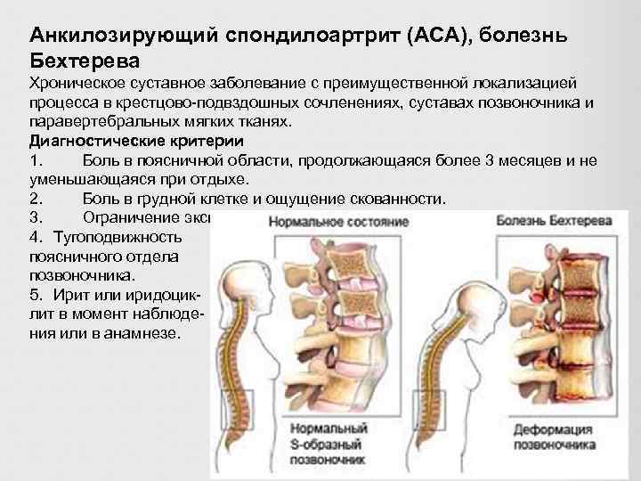 Анкилозирующий спондилоартрит (АСА), болезнь Бехтерева Хроническое суставное заболевание с преимущественной локализацией процесса в крестцово-подвздошных