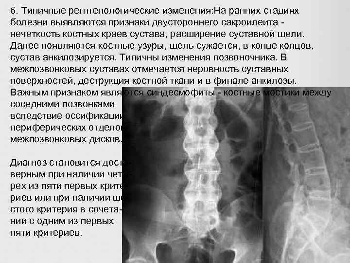 6. Типичные рентгенологические изменения: На ранних стадиях болезни выявляются признаки двустороннего сакроилеита нечеткость костных
