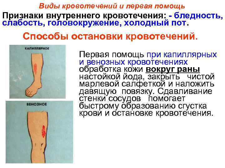 Виды кровотечений и первая помощь Признаки внутреннего кровотечения: - бледность, слабость, головокружение, холодный пот.