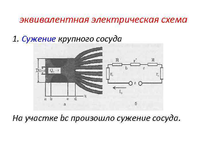 эквивалентная электрическая схема 1. Сужение крупного сосуда На участке bс произошло сужение сосуда. 