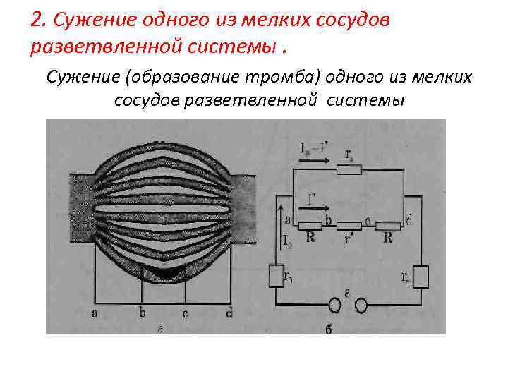 2. Сужение одного из мелких сосудов разветвленной системы. Сужение (образование тромба) одного из мелких