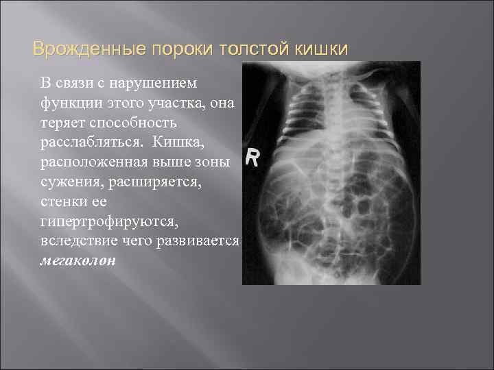 Врожденные пороки толстой кишки В связи с нарушением функции этого участка, она теряет способность