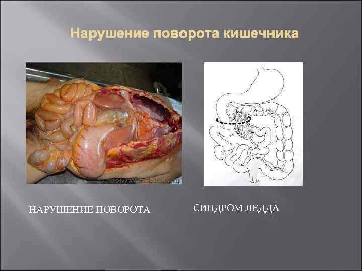 НАРУШЕНИЕ ПОВОРОТА СИНДРОМ ЛЕДДА 