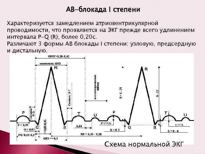 АВ-блокада I степени Характеризуется замедлением атриовентрикулярной проводимости, что проявляется на ЭКГ прежде всего удлинением