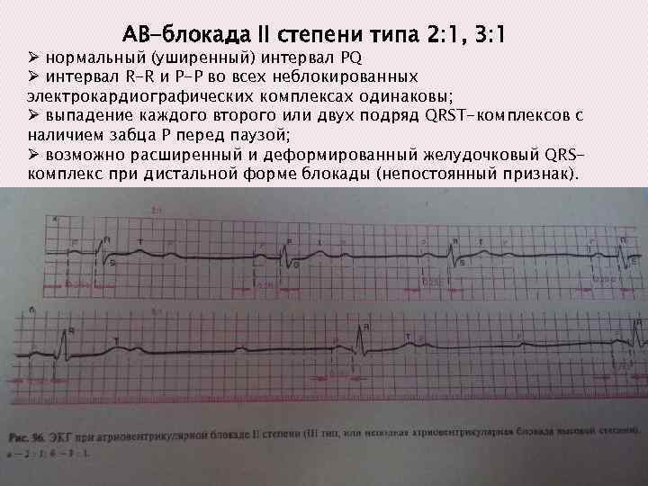 АВ-блокада II степени типа 2: 1, 3: 1 Ø нормальный (уширенный) интервал PQ Ø