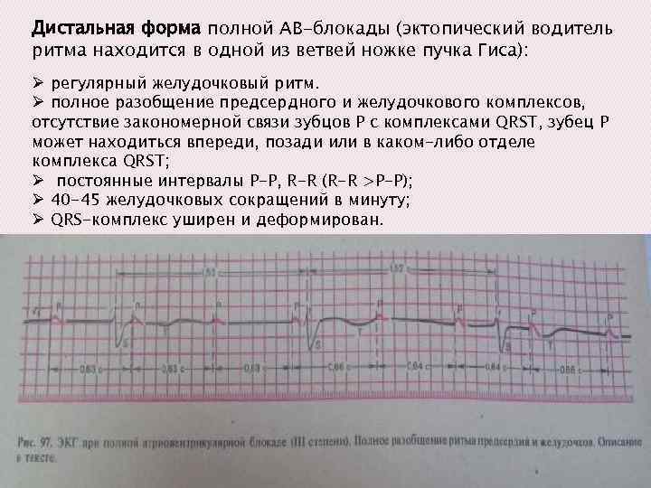 Дистальная форма полной АВ-блокады (эктопический водитель ритма находится в одной из ветвей ножке пучка