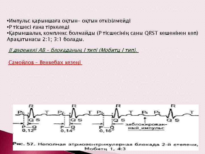 ІІ дәрежелі АВ – блокада (Венкебах – Самойлов кезеңдері бар ІІ дәрежелі толық емес