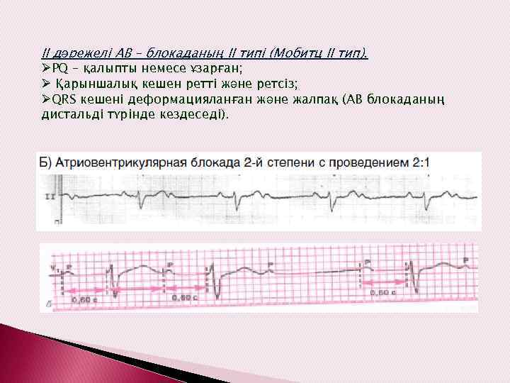 ІІ дәрежелі АВ – блокаданың ІІ типі (Мобитц ІІ тип). ØPQ – қалыпты немесе