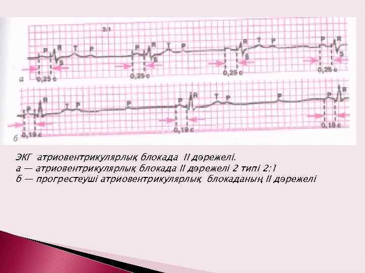 ЭКГ атриовентрикулярлық блокада II дәрежелі. а — атриовентрикулярлық блокада II дәрежелі 2 типі 2: