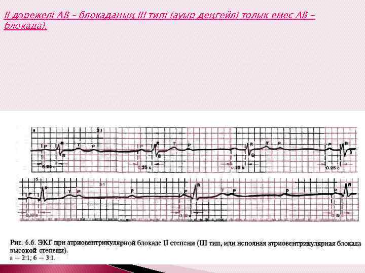 ІІ дәрежелі АВ – блокаданың ІІІ типі (ауыр деңгейлі толық емес АВ блокада). ЭКГ
