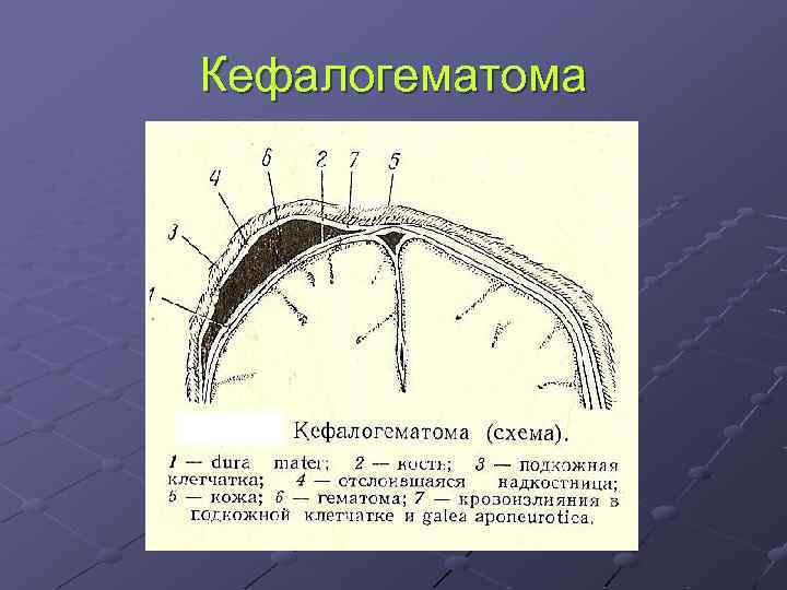 Кефалогематома 