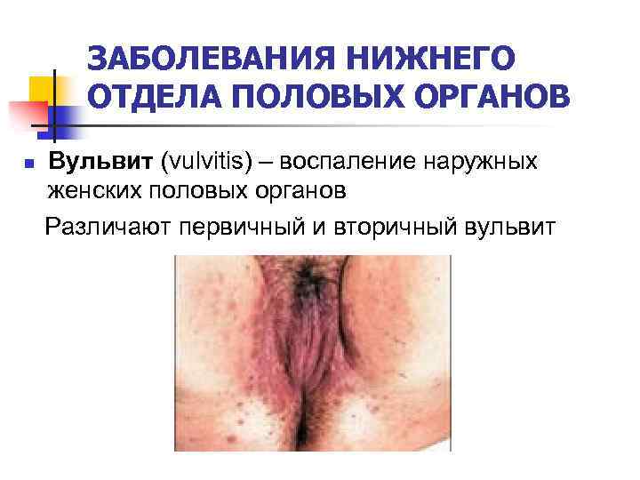 ЗАБОЛЕВАНИЯ НИЖНЕГО ОТДЕЛА ПОЛОВЫХ ОРГАНОВ n Вульвит (vulvitis) – воспаление наружных женских половых органов