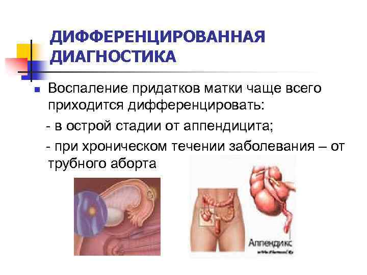 ДИФФЕРЕНЦИРОВАННАЯ ДИАГНОСТИКА n Воспаление придатков матки чаще всего приходится дифференцировать: - в острой стадии