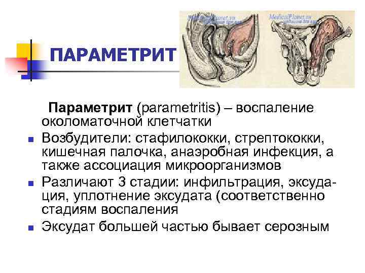 ПАРАМЕТРИТ n n n Параметрит (parametritis) – воспаление околоматочной клетчатки Возбудители: стафилококки, стрептококки, кишечная