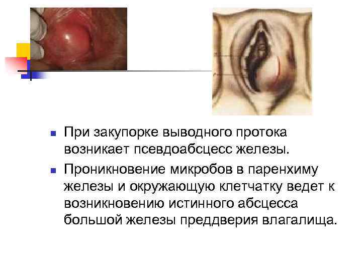 n n При закупорке выводного протока возникает псевдоабсцесс железы. Проникновение микробов в паренхиму железы