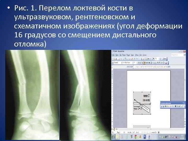  • Рис. 1. Перелом локтевой кости в ультразвуковом, рентгеновском и схематичном изображениях (угол