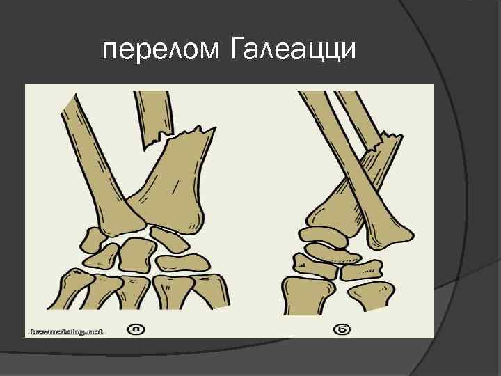 Перелом колеса и смита презентация