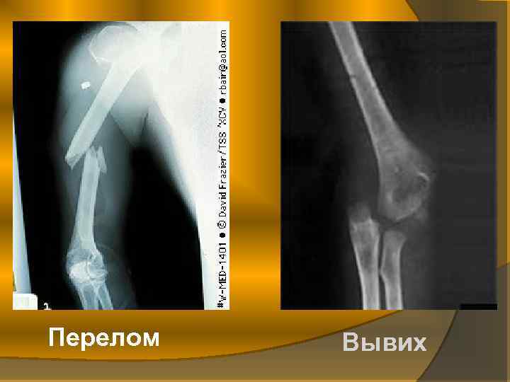 Переломы и вывихи общая хирургия презентация