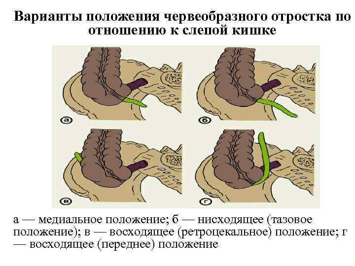 Особенности клинической картины острого аппендицита при тазовом расположении червеобразного отростка