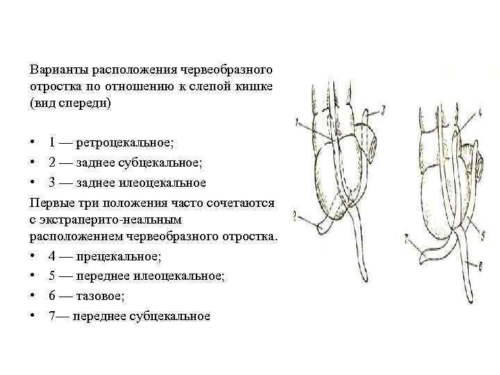 Перфорация слепой кишки что это