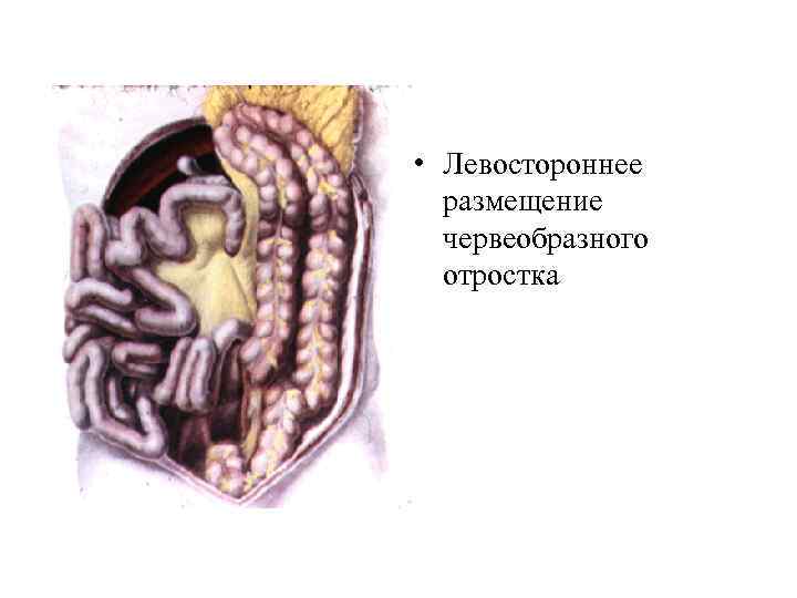  • Левостороннее размещение червеобразного отростка 