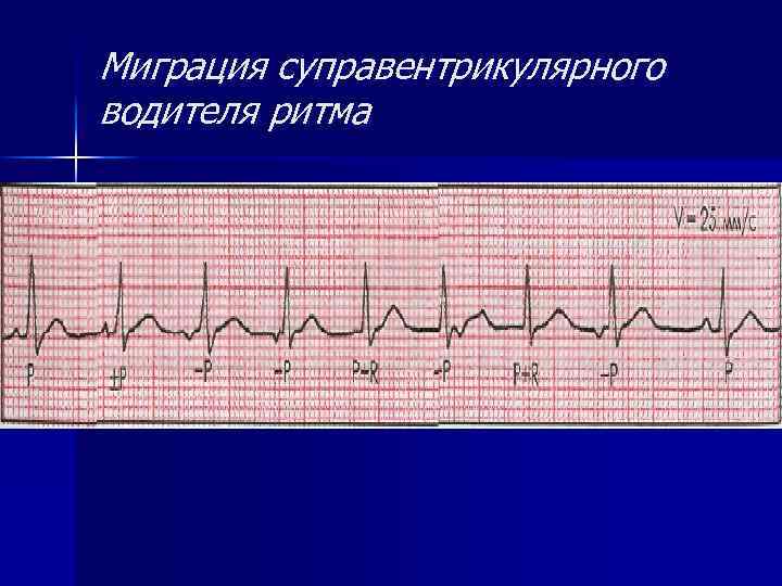 Миграция суправентрикулярного водителя ритма 