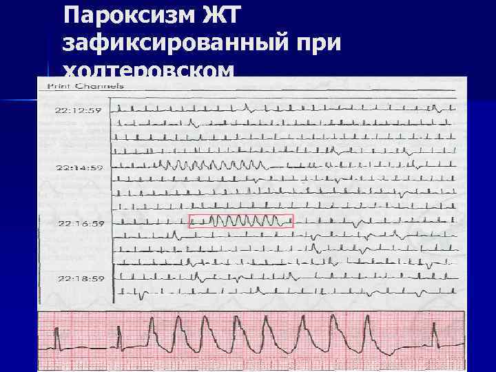 Пароксизм ЖТ зафиксированный при холтеровском мониторировании 