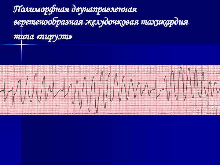 Полиморфная двунаправленная веретенообразная желудочковая тахикардия типа «пируэт» 