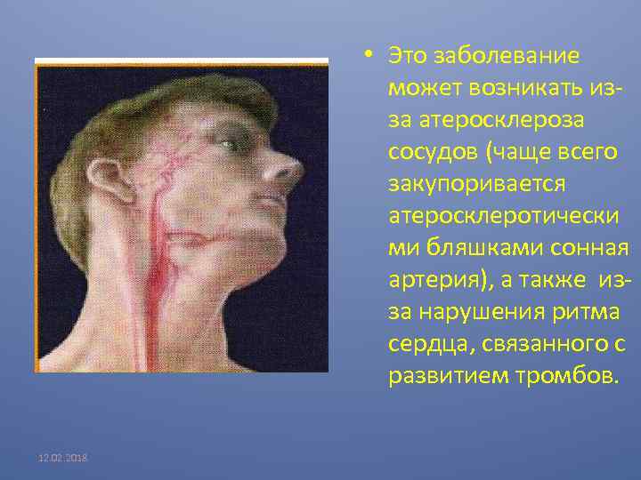  • Это заболевание может возникать изза атеросклероза сосудов (чаще всего закупоривается атеросклеротически ми