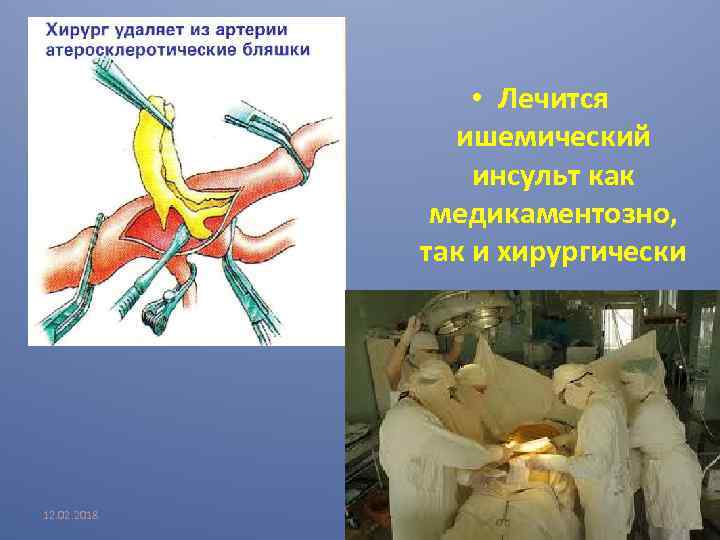  • Лечится ишемический инсульт как медикаментозно, так и хирургически 12. 02. 2018 В.