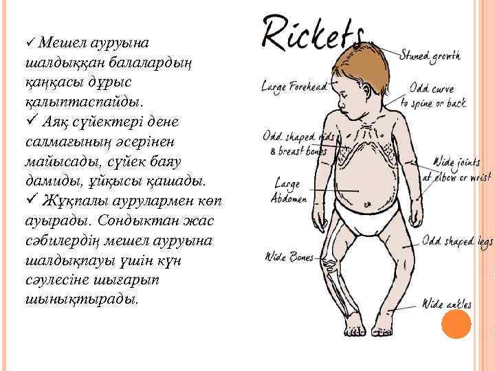 ü Мешел ауруына шалдыққан балалардың қаңқасы дұрыс қалыптаспайды. ü Аяқ сүйектері дене салмағының әсерінен
