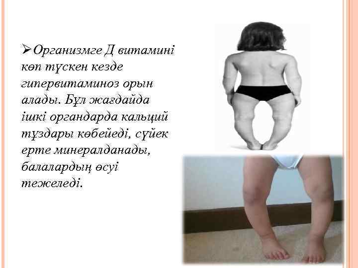 ØОрганизмге Д витамині көп түскен кезде гипервитаминоз орын алады. Бұл жағдайда ішкі органдарда кальций