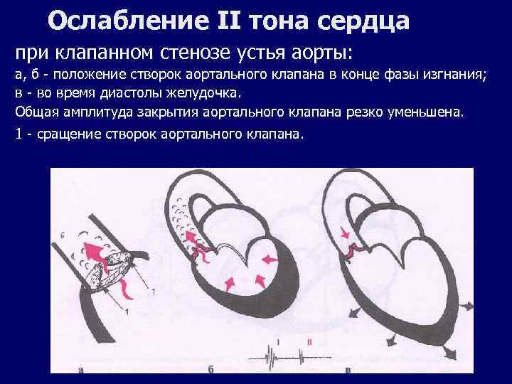 Ослабление II тона сердца при клапанном стенозе устья аорты: а, б - положение створок