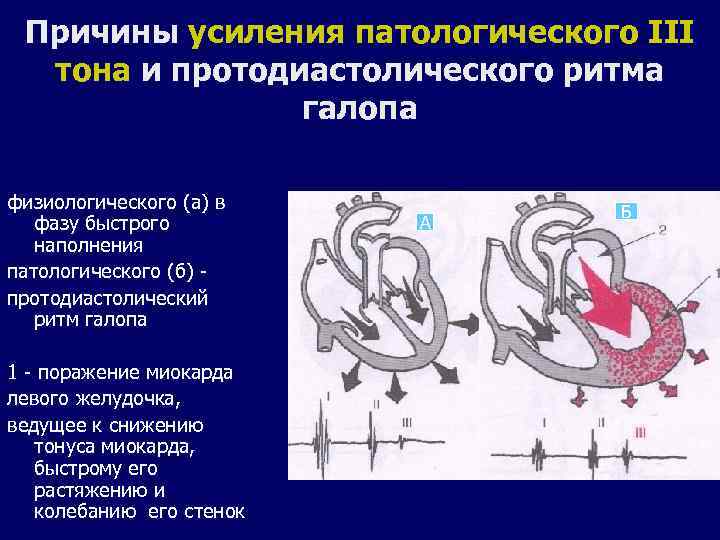 Причины усиления патологического III тона и протодиастолического ритма галопа физиологического (а) в фазу быстрого