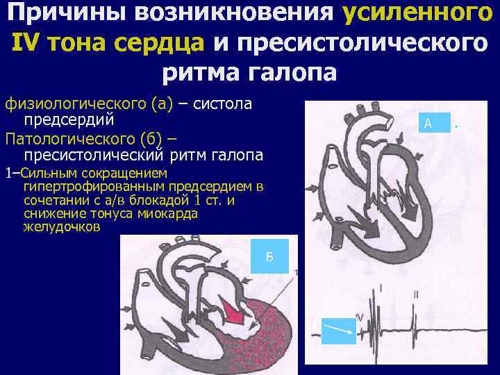 Неполное сердце. Пресистолический ритм галопа. Ритм галопа аускультация сердца. Протодиастолический ритм галопа. Ритм галопа причины возникновения.