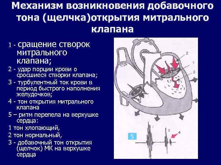 Механизм возникновения добавочного тона (щелчка)открытия митрального клапана 1 - сращение створок митрального клапана; 2