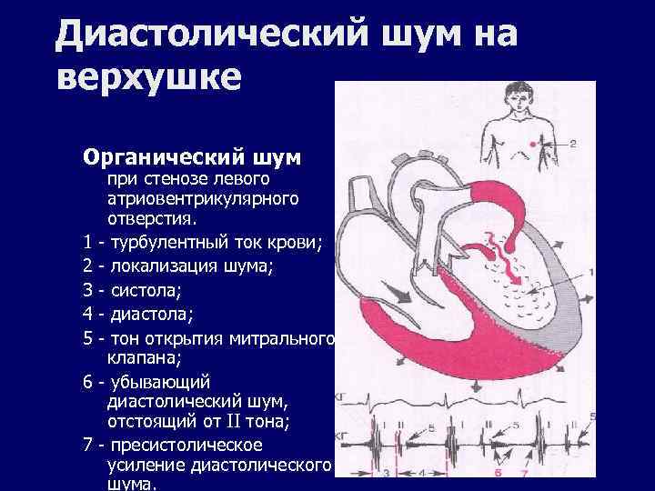 Какие симптомы характерны для аускультативной картины недостаточности митрального клапана тест