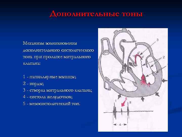 Дополнительные тоны Механизм возникновения дополнительного систолического тона при пролапсе митрального клапана: 1 - папиллярные