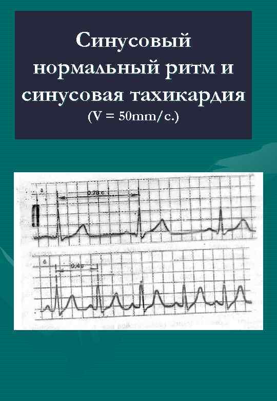 Синусовый нормальный ритм и синусовая тахикардия (V = 50 mm/с. ) 