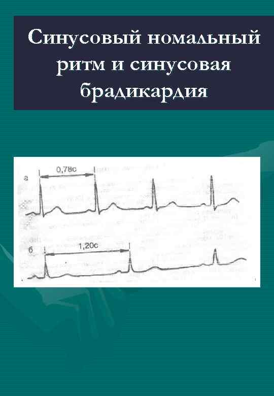 Синусовый номальный ритм и синусовая брадикардия 