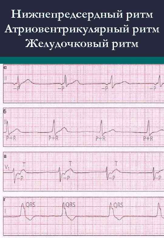 Нижнепредсердный ритм Атриовентрикулярный ритм Желудочковый ритм 