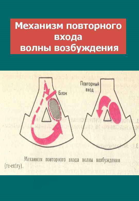 Механизм повторного входа волны возбуждения 