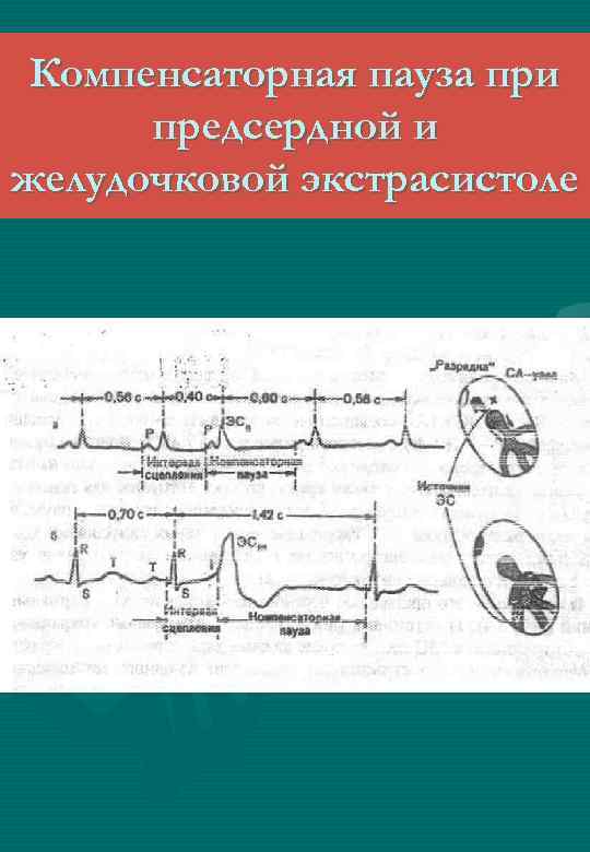 Компенсаторная пауза при предсердной и желудочковой экстрасистоле 