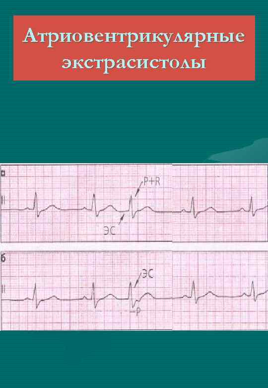 Атриовентрикулярные экстрасистолы 