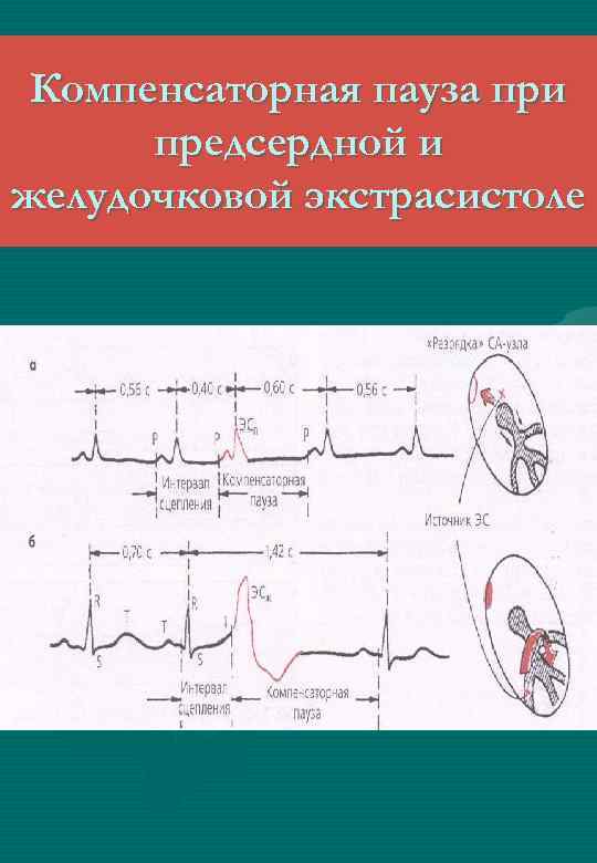 Компенсаторная пауза при предсердной и желудочковой экстрасистоле 