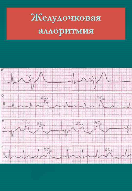 Желудочковая аллоритмия 