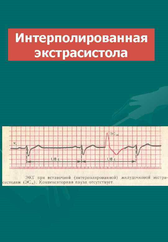 Интерполированная экстрасистола 