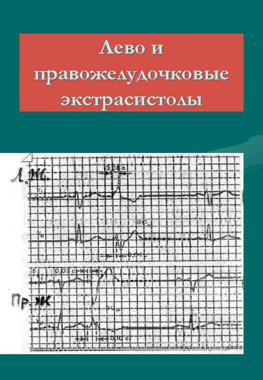 Лево и правожелудочковые экстрасистолы 