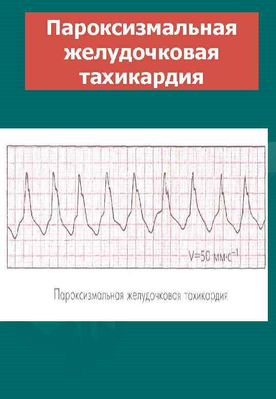 Пароксизмальная желудочковая тахикардия 