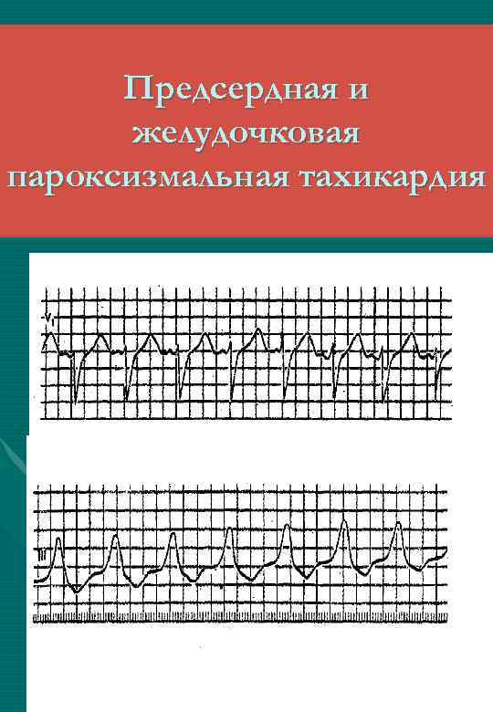 Предсердная и желудочковая пароксизмальная тахикардия 